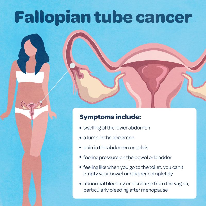 Cancer Of The Fallopian Tubes