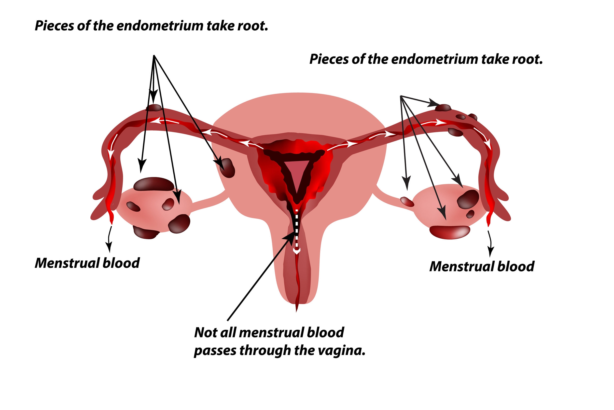 Endometriosis